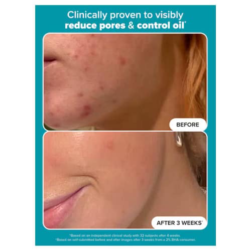 Paula's Choice Skin Perfecting 2% BHA Liquid Exfoliant