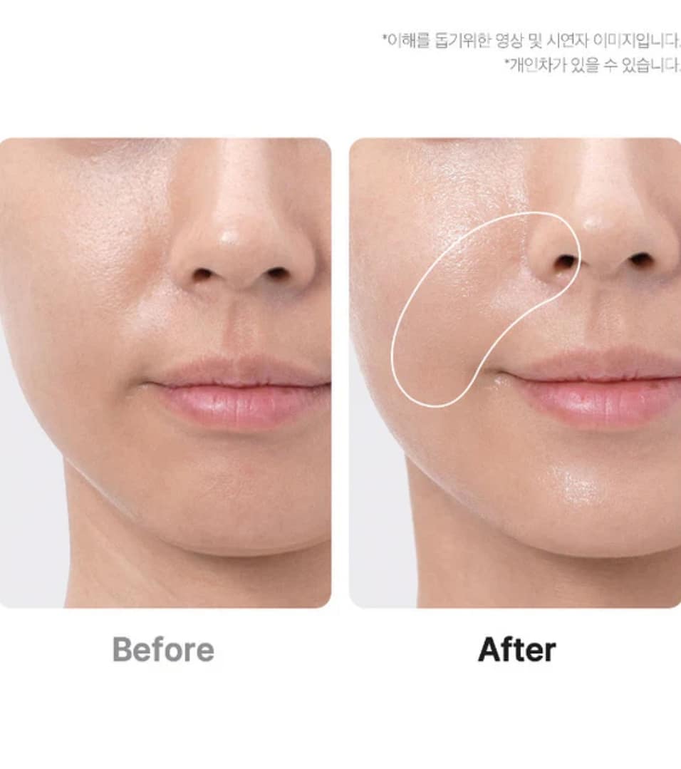 pre i posle korišćenja aparata