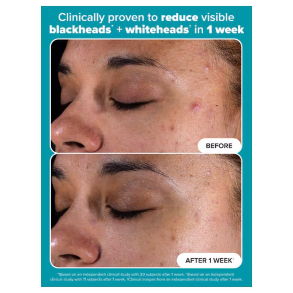 Paula's Choice Skin Perfecting 2% BHA Liquid Exfoliant